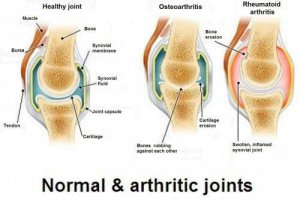 ऑस्टियोआर्थराइटिस, ऑस्टियोपोरोसिस और आर्थराइटिस : तीनों में क्या अंतर हैं?