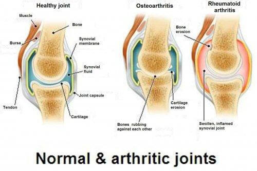 ऑस्टियोआर्थराइटिस, ऑस्टियोपोरोसिस और आर्थराइटिस : तीनों में क्या अंतर हैं?