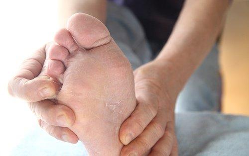 पैरों को सिरका में भिगोना फंगस से छुटकारा दिलाता है