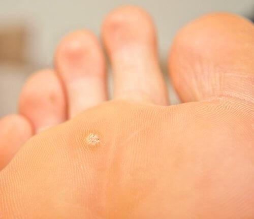 सिरका मस्सों (warts) को खत्म करता है