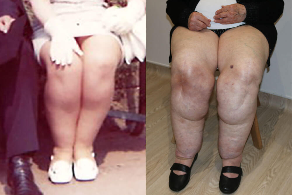 लिपेडेमा के साथ जीना किसी चुनौती से कम नहीं होता