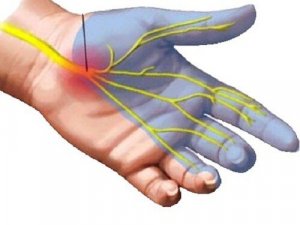 कलाई के दर्द में क्या होता है