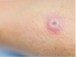 फोड़े क्यों उभरते हैं?