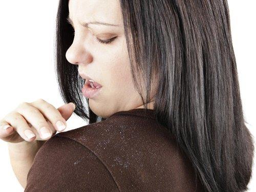 डैन्ड्रफ से परेशान महिला