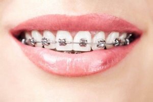 डेंटल एजेनिसिस Dental Agenesis