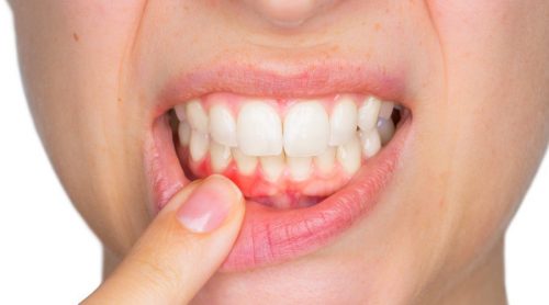 दांत का फोड़ा और उसका इलाज कैसे करें
