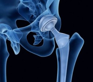 कूल्हे की समस्याएं : ऑस्टियोजेनेसिस इम्पर्फेक्टा (Osteogenesis imperfecta)