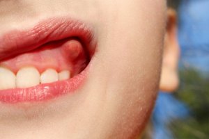 दांत का फोड़ा क्या होता हैं?