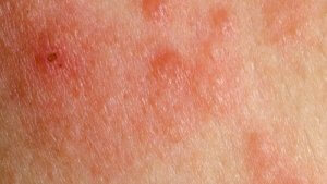 त्वचा कैंसर : लाली और सूजन (Redness and swelling)