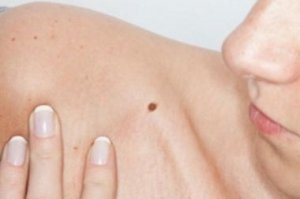 त्वचा कैंसर : तिल या मस्से का उभरना (Appearance of moles)