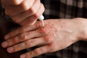 सोरायसिस : ट्रेडिशनल कॉर्टिकोस्टेरॉइड (corticosteroids)