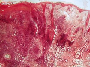 सिस्टेमिक ल्यूपस एरिथेमेटोसस : पैथोजेन