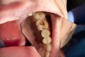 दांतों की क्षय : क्यों होती है डेंटल कैविटी?