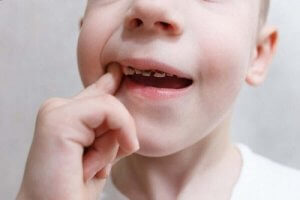 डेंटल कैविटी : दांत क्यों सड़ते हैं