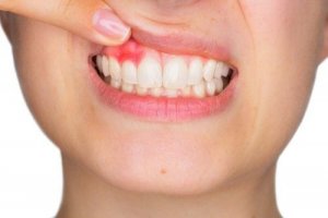 मसूड़ों से खून आना : पीरियडोंटाइटिस (periodontitis)
