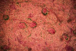 रेनल ट्यूबरक्लोसिस : डायग्नोसिस और ट्रीटमेंट