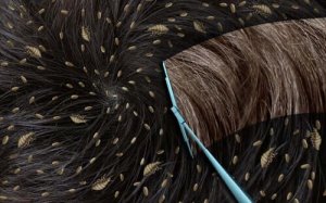 लीख क्या है और कैसे फैलती हैं