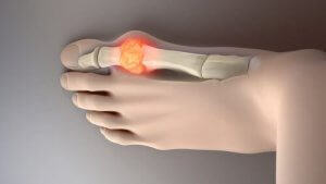 यूरिक एसिड लेवल घटाने के लिए इन 8 आदर्श खाद्यों को आजमायें