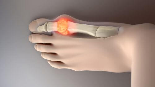 यूरिक एसिड लेवल घटाने के लिए इन 8 आदर्श खाद्यों को आजमायें