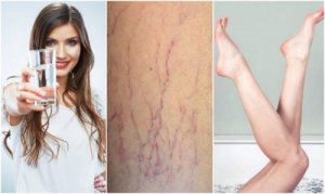 6 टिप्स वैरिकोज वेन्स को रोकने के लिए