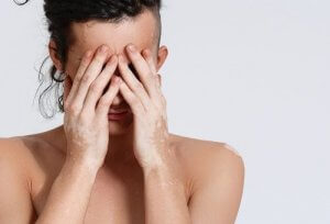 विटिलिगो क्या है? कारण और इलाज के बारे में जानें