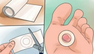 छाले को हमेशा सूखा रखें