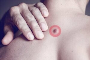 पीठ पर फैटी लम्प होने के कारण