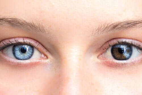 आंखों के रंग में बदलाव गंभीर हो सकता है
